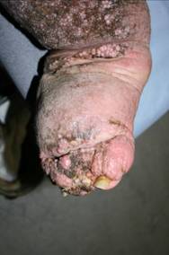 Figure 4 – Severe skin changes in advanced lymphoedema of the lower leg